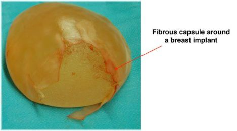 fibrous capsule around a breast implant