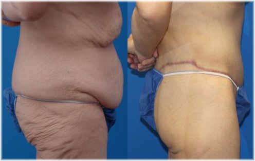 before and after belt lipectomy