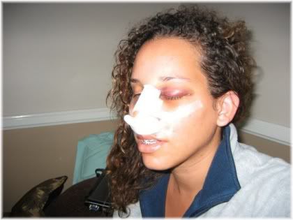 bruising after rhinoplasty