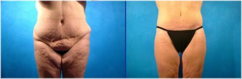 thigh lift and abdominoplasty