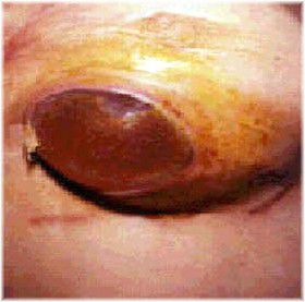 exposed breast implant