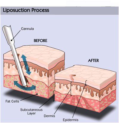 liposuction process