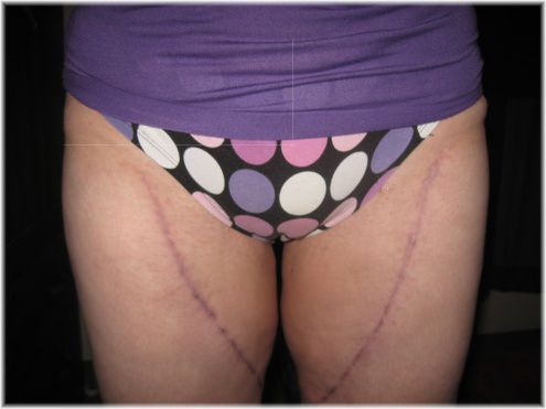 thigh lift scars