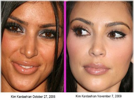 Kim Kardashian before after plastic surgery