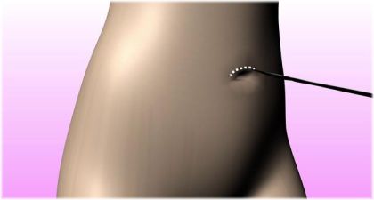 transumbilical incision