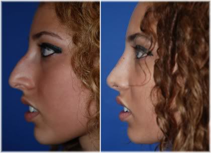 reduction rhinoplasty