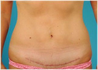 mini tummy tuck