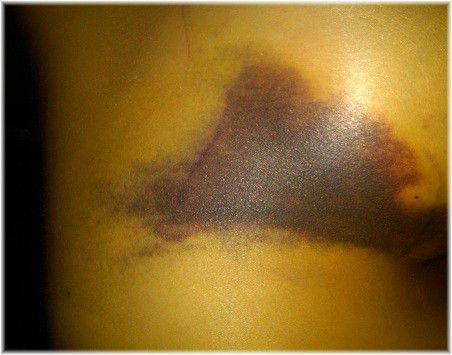 bruising of breast