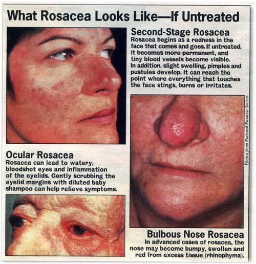 rosacea stages