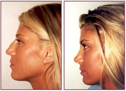 before after rhinoplasty female