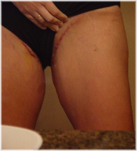 thigh lift scar