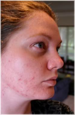 acne woman